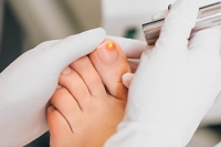 Laser Therapy and Toenail Fungus