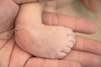 Understanding Clubfoot in Infants