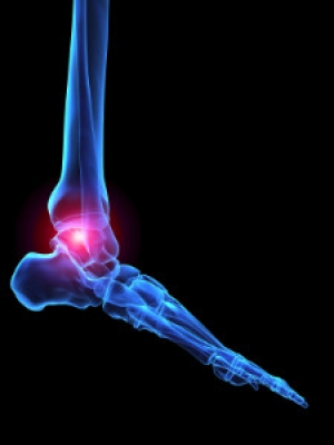 Ankle Osteoarthritis