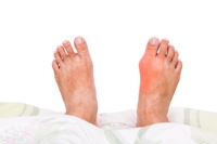 Can Gout Be Prevented?