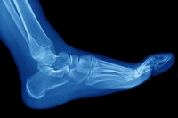 Causes and Symptoms of Foot Stress Fractures