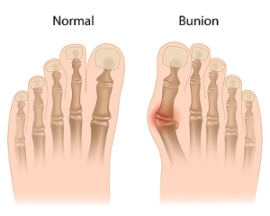 Are Bunions Genetic?