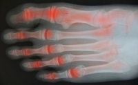 Foot Pain May Indicate Arthritis