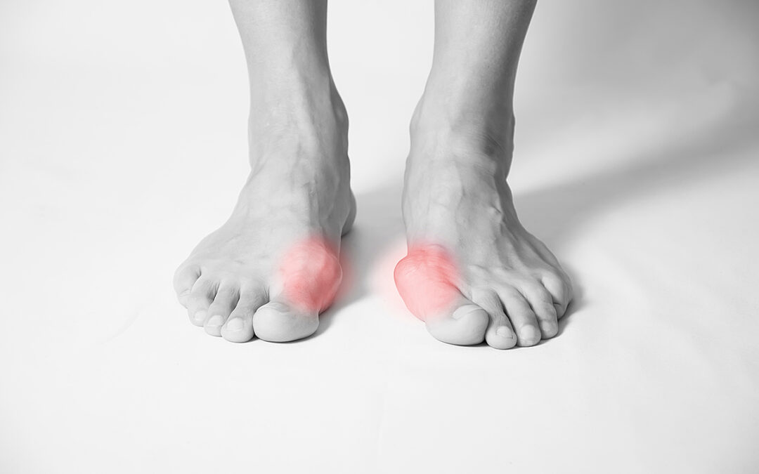 How Do Bunions Form and What Can You Do?