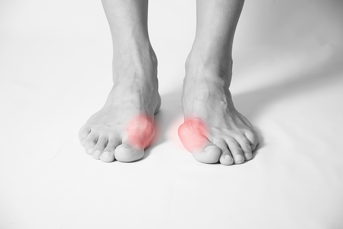 bunion in foot