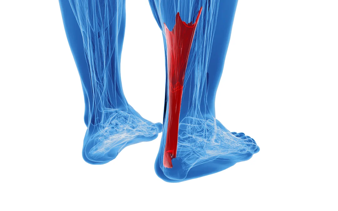 The Impact of Overuse on the Achilles Tendon