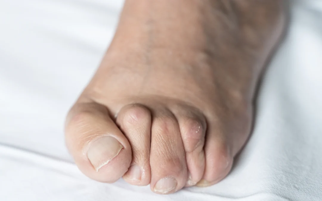 What Are Hammertoes? Symptoms and Solutions
