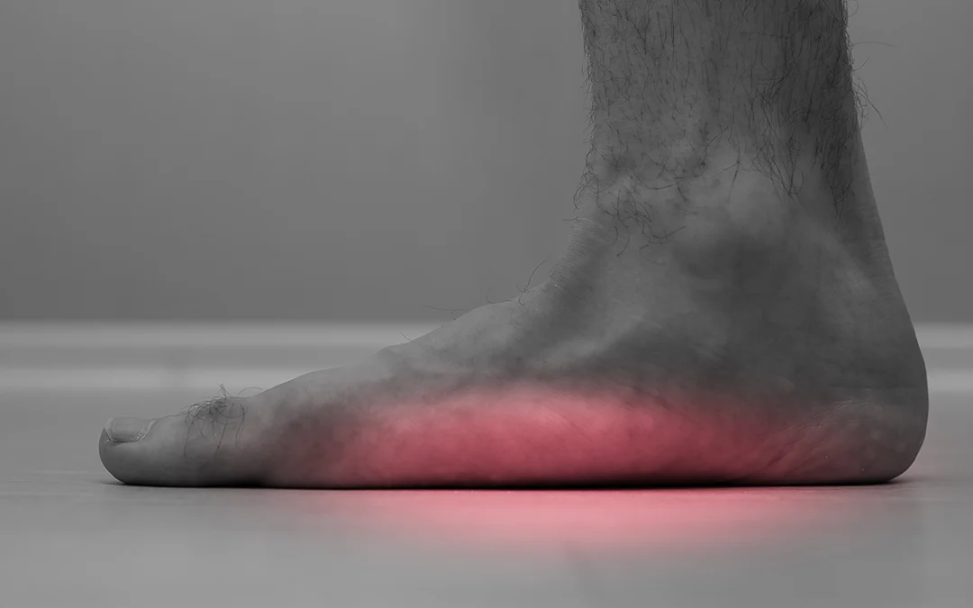 What Is Flexible Flat Foot?