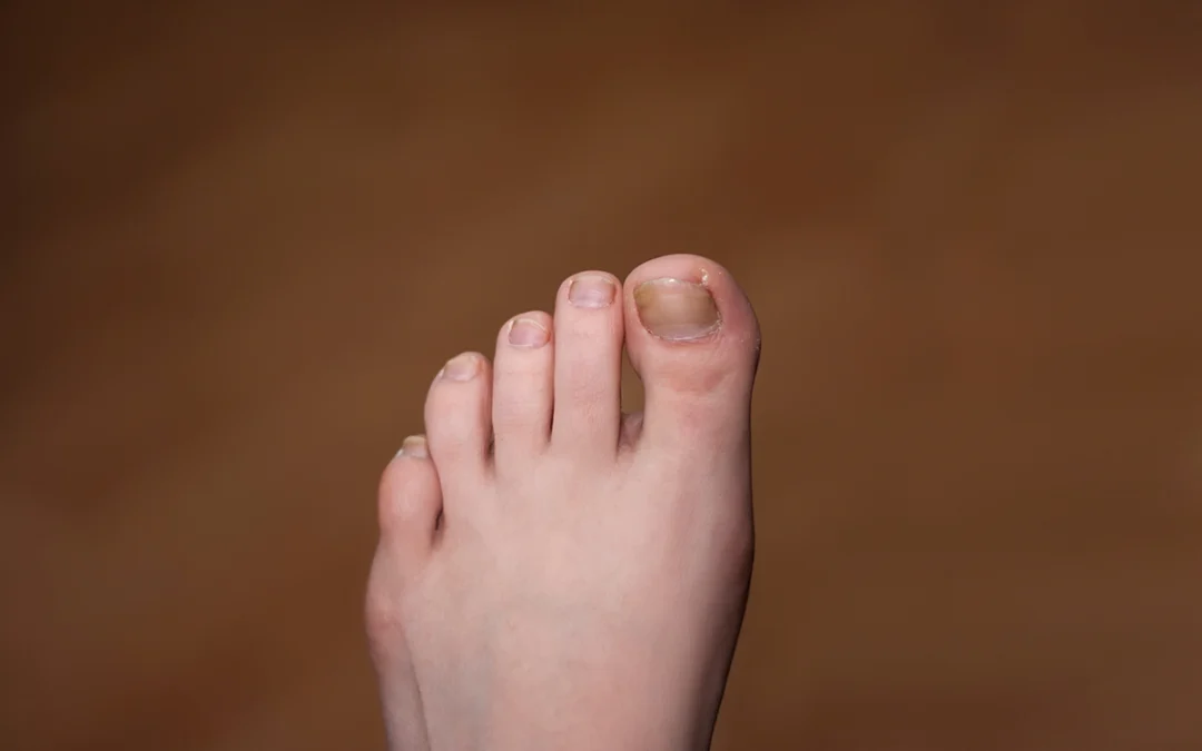 Understanding and Treating Ingrown Toenails