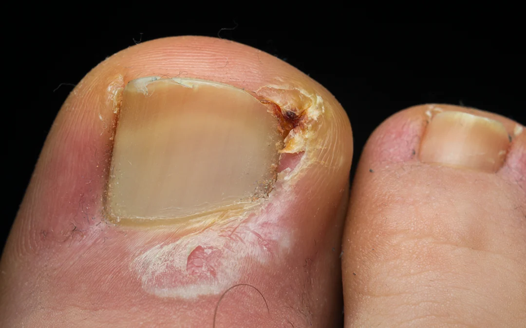 Why Ingrown Toenails Develop: Causes Explained