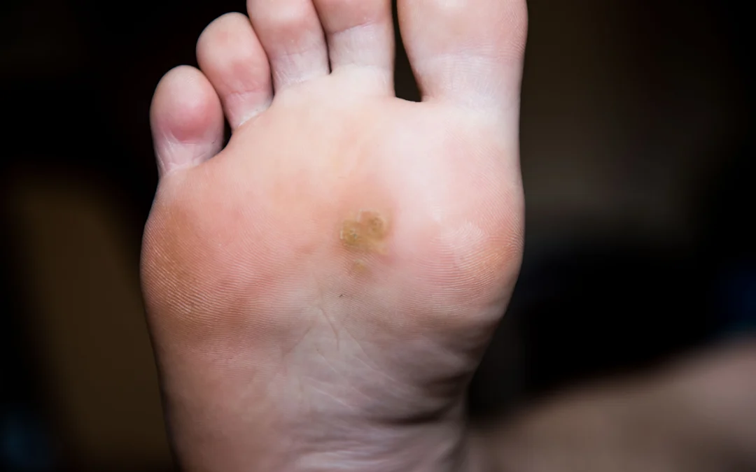 Common Symptoms of Corns