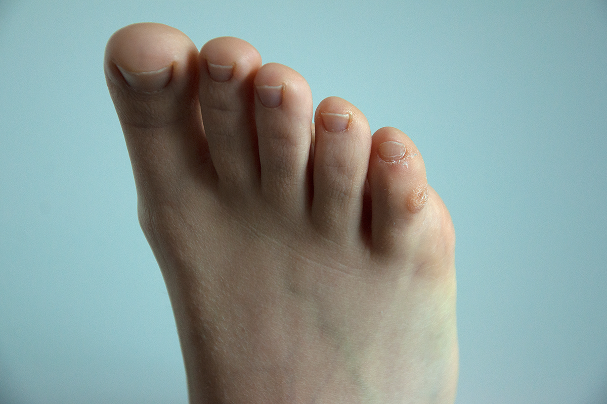 corn on the little toe of a foot corn on the little toe of a foot