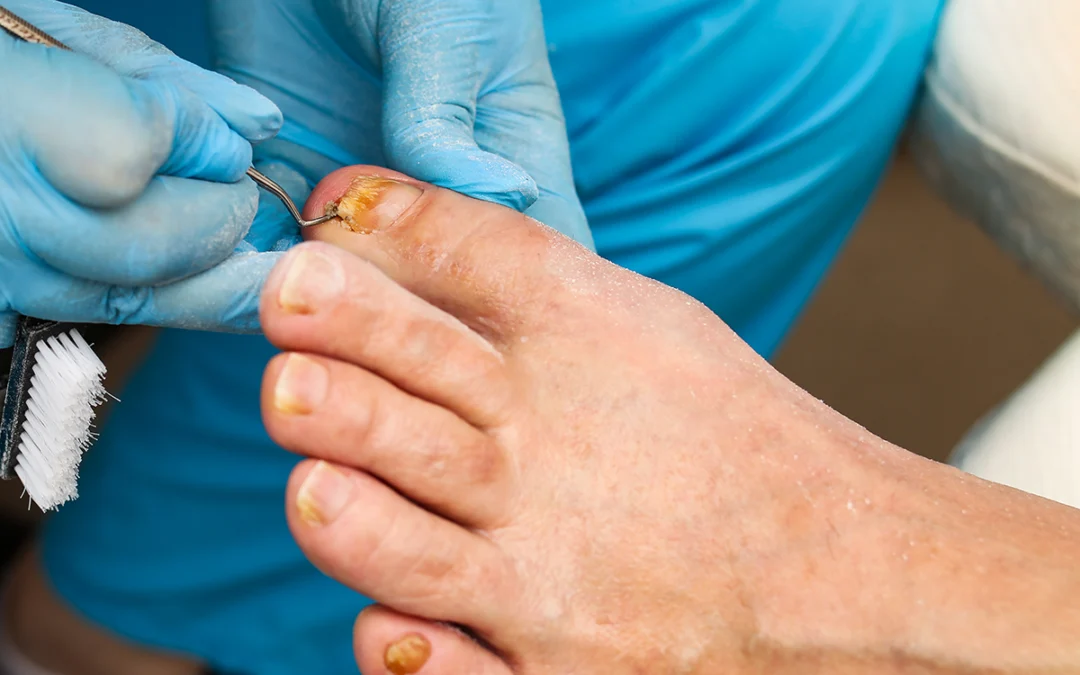Treating Ingrown Toenails: Best Practices
