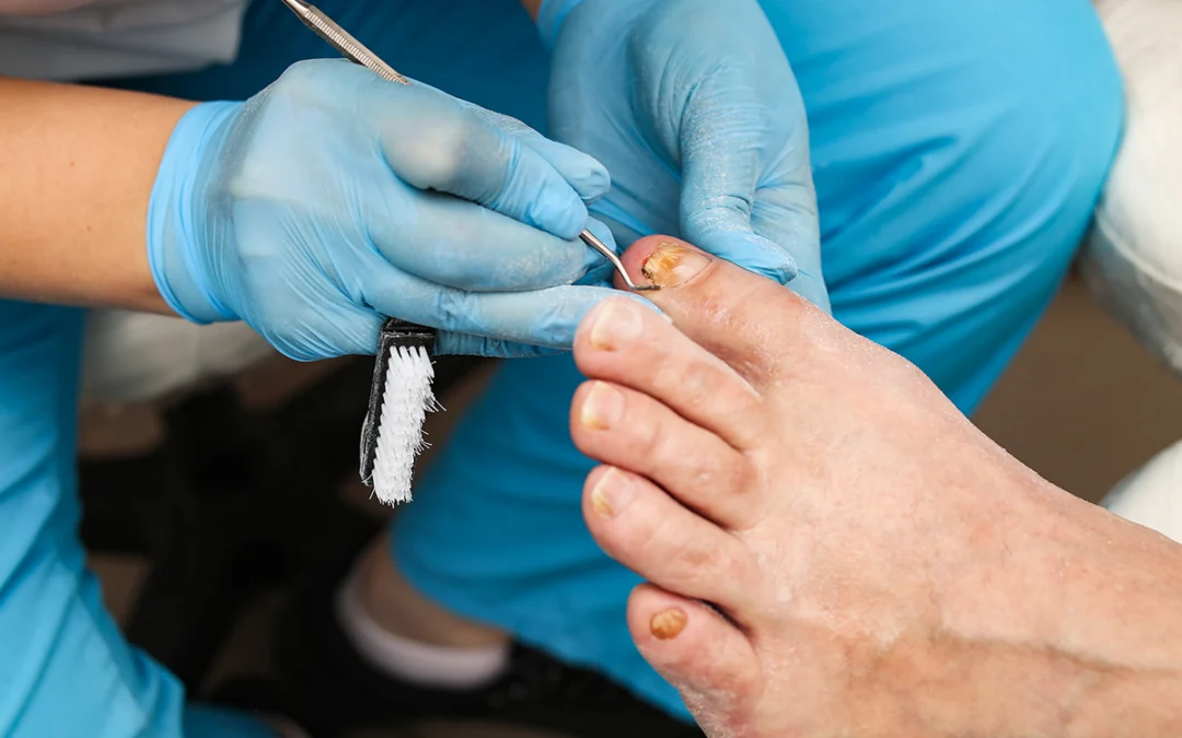 What You Should Know About Ingrown Toenails