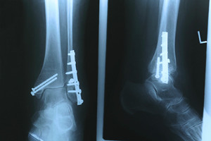 foot with stress fracture