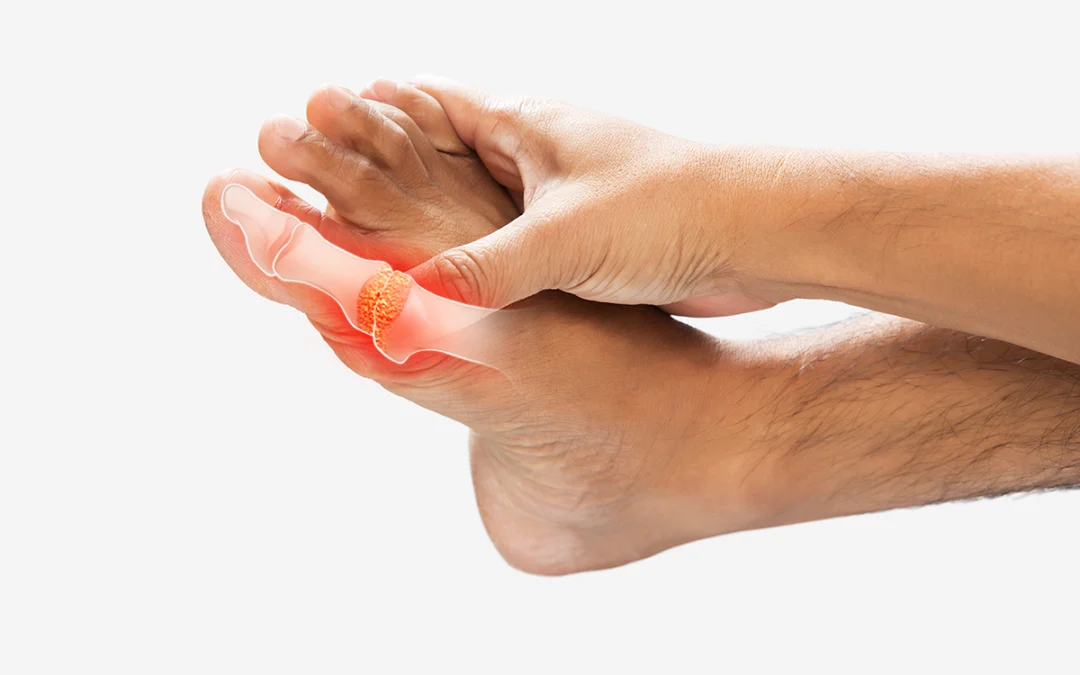 Overview and Management of Gout
