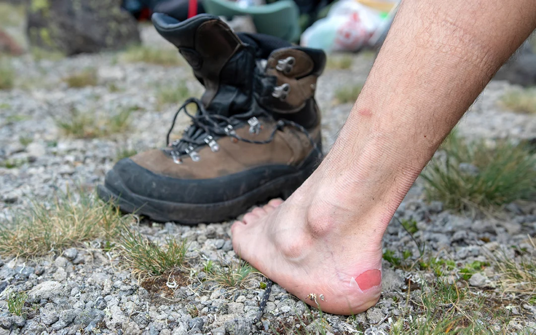 Everything You Need to Know About Blisters