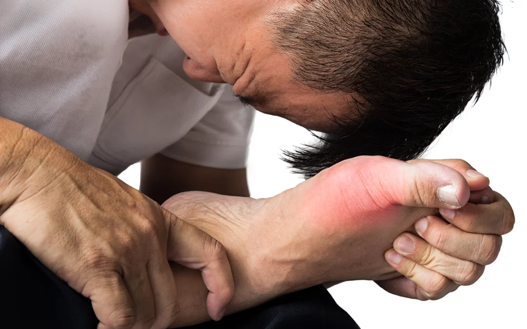 Managing Painful Gout: Effective Strategies