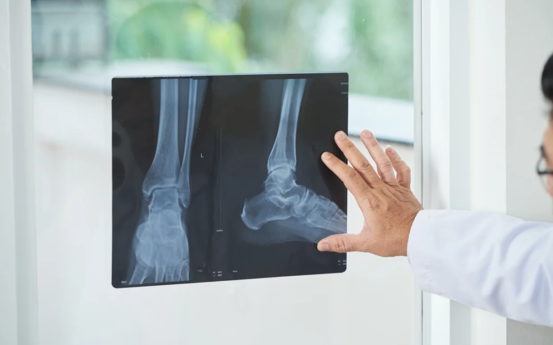 What Does a Negative Ankle X-Ray Mean?