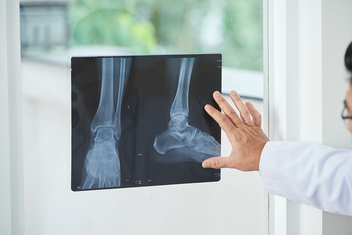 medical practitioner examining x ray picture of ankle medical practitioner examining x ray picture of ankle