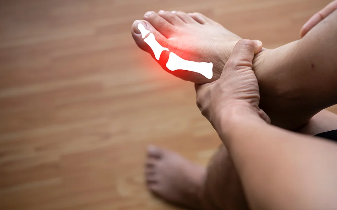 Who is Most Susceptible to Getting Gout