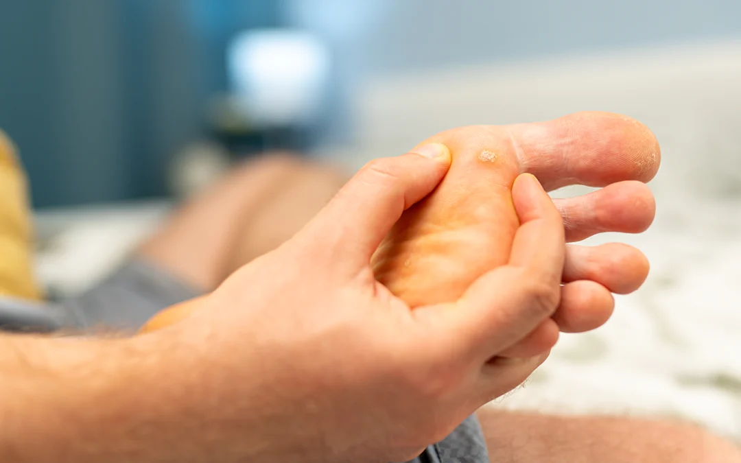Everything You Should Know About Plantar Warts