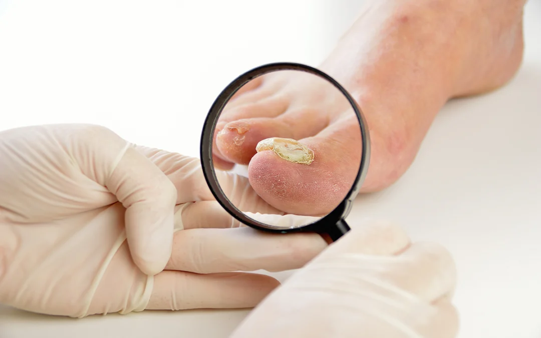 Factors That Influence Toenail Fungus Development