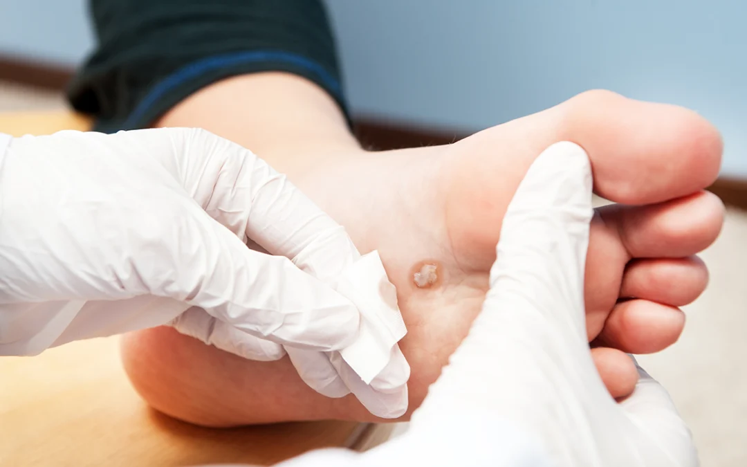 How Plantar Warts Can Be Treated Successfully