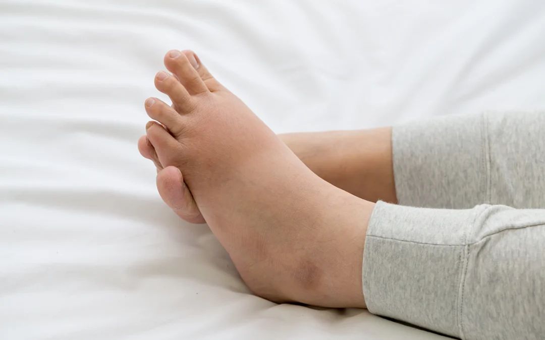 Understanding Poor Circulation: Causes and Solutions
