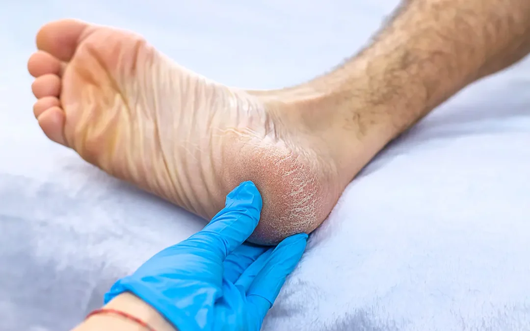 Solutions for Cracked Heels: Prevention and Care