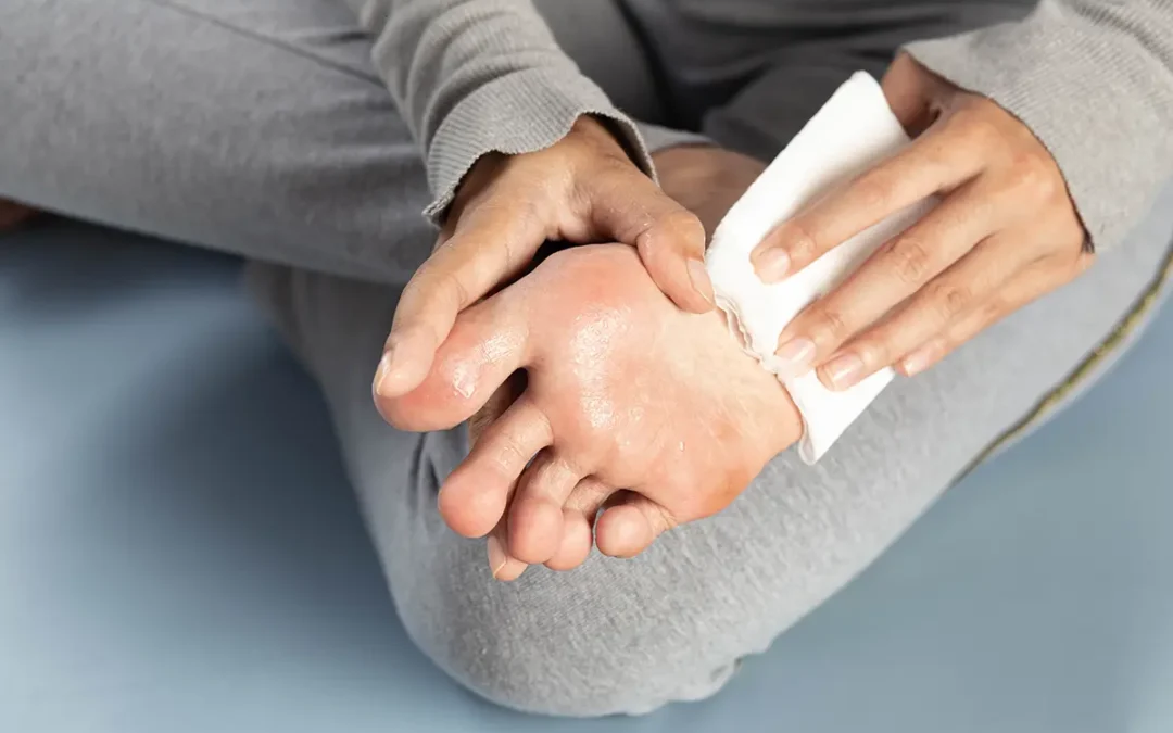 Excessive Foot Sweat: Causes and Effective Treatments