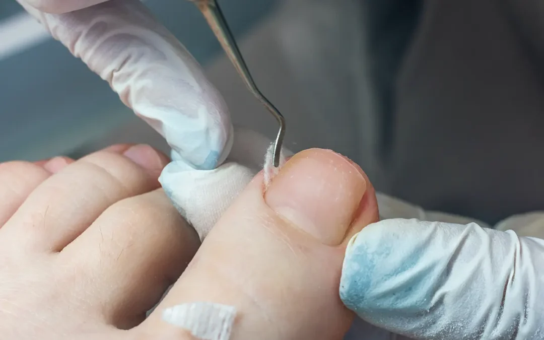 Possible Treatments for Ingrown Toenails: What You Should Know