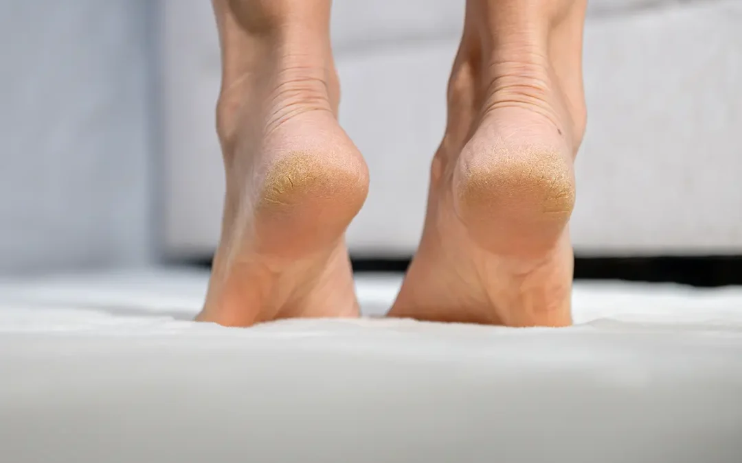 What Causes Heel Fissures?