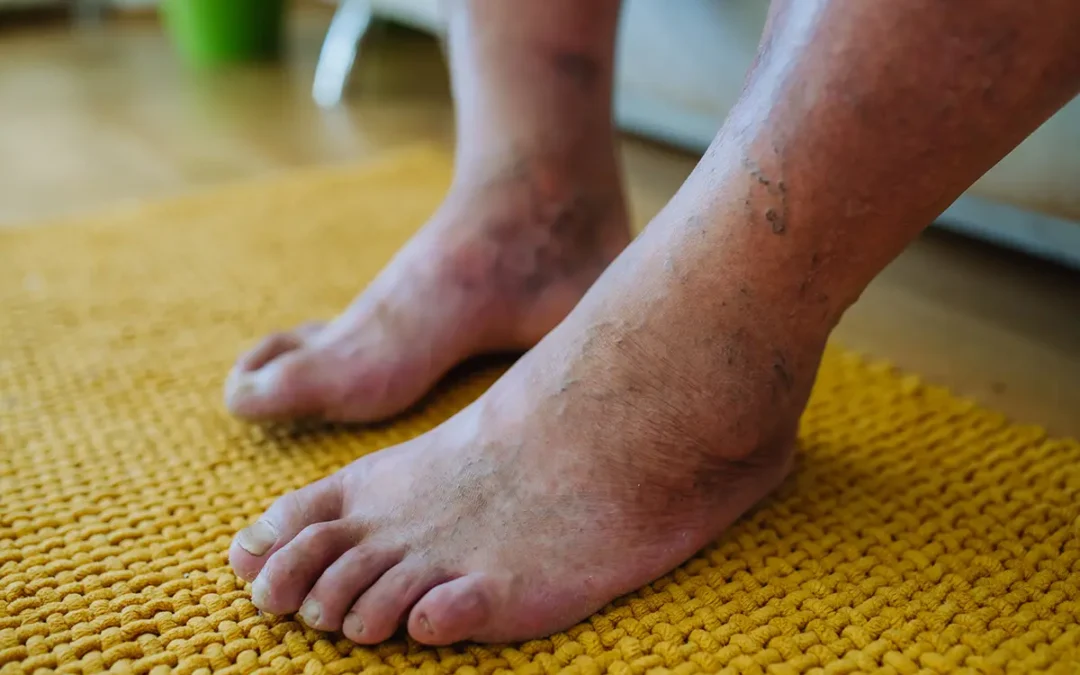 Systemic Diseases That Affect the Foot