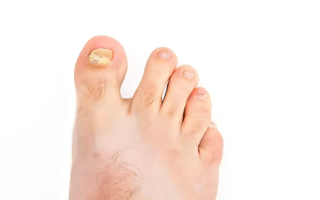 Toenail Fungus Facts: How to Prevent and Treat This Common Issue