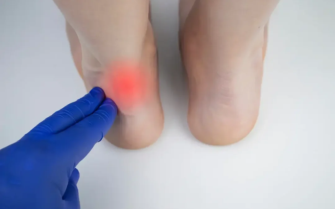 How to Test for an Achilles Tendon Injury: A Simple Guide