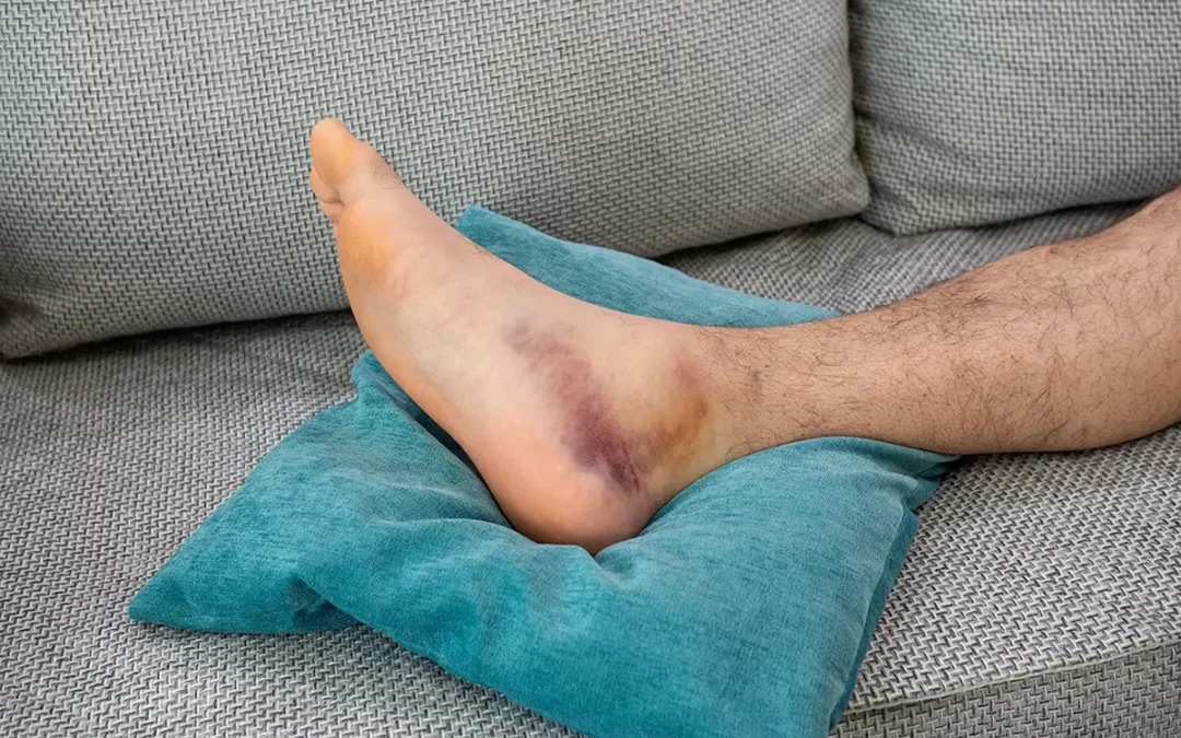 Symptoms of a Broken Ankle to Recognize