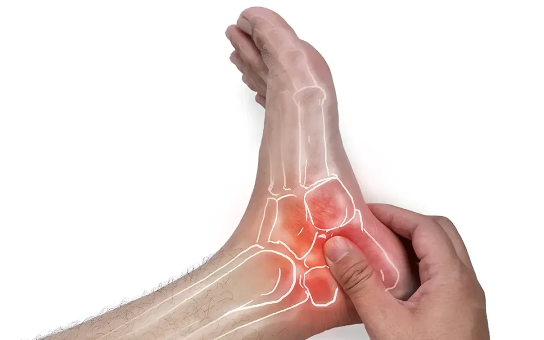 Stress Fractures May Affect the Ankles
