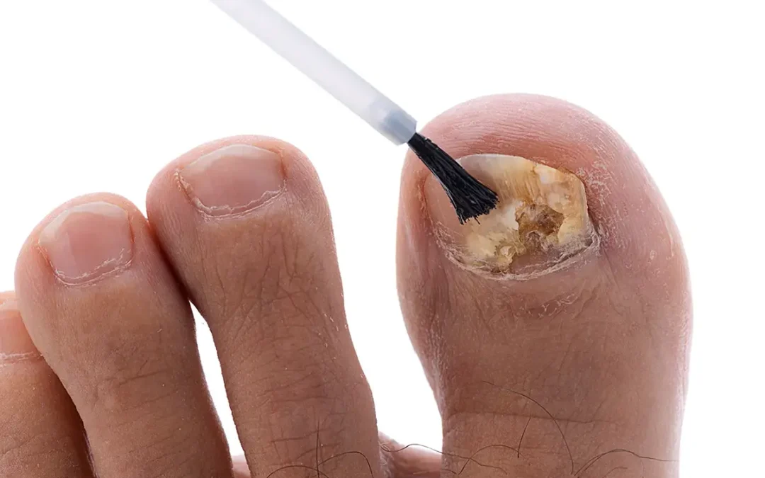 Ingrown Toenail Care: What You Should Know