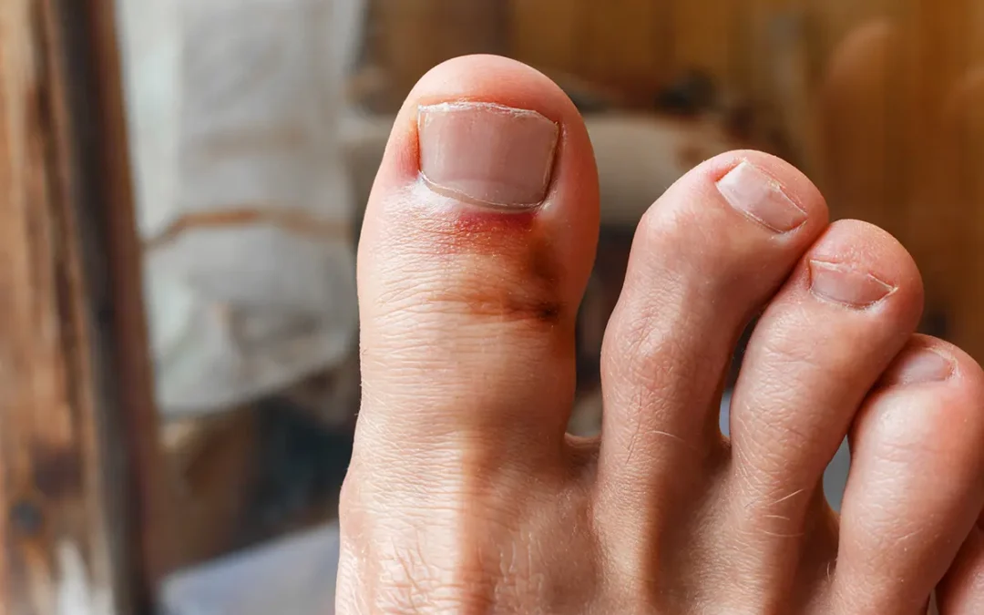 Common Treatment Options for a Broken Toe: What to Expect