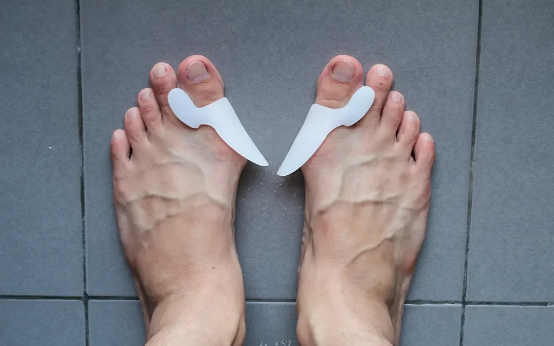 Bunion Treatment: What Are Your Options?
