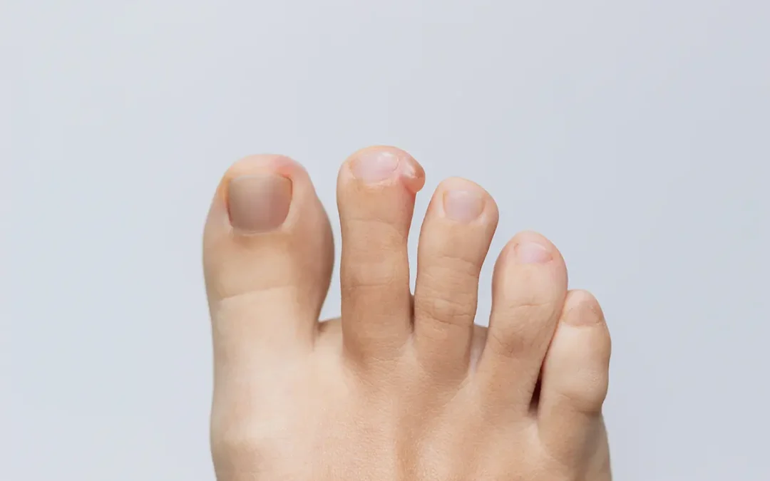 Causes of Blisters Between the Toes and How to Prevent Them