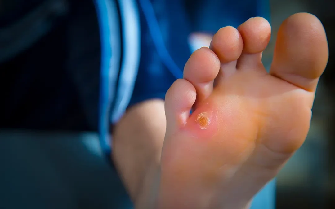 How to Treat and Prevent Foot Corns for Healthy Feet