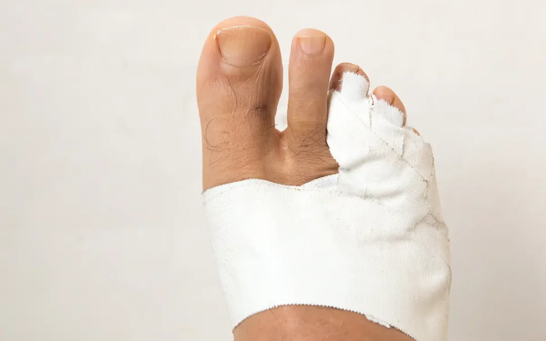 Rehabilitation Exercises to Help Heal a Broken Toe