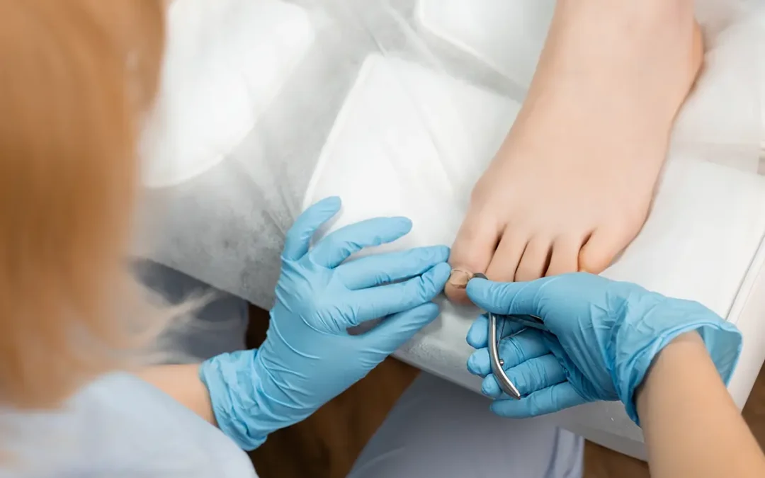 Effective Strategies for Managing Ingrown Toenails