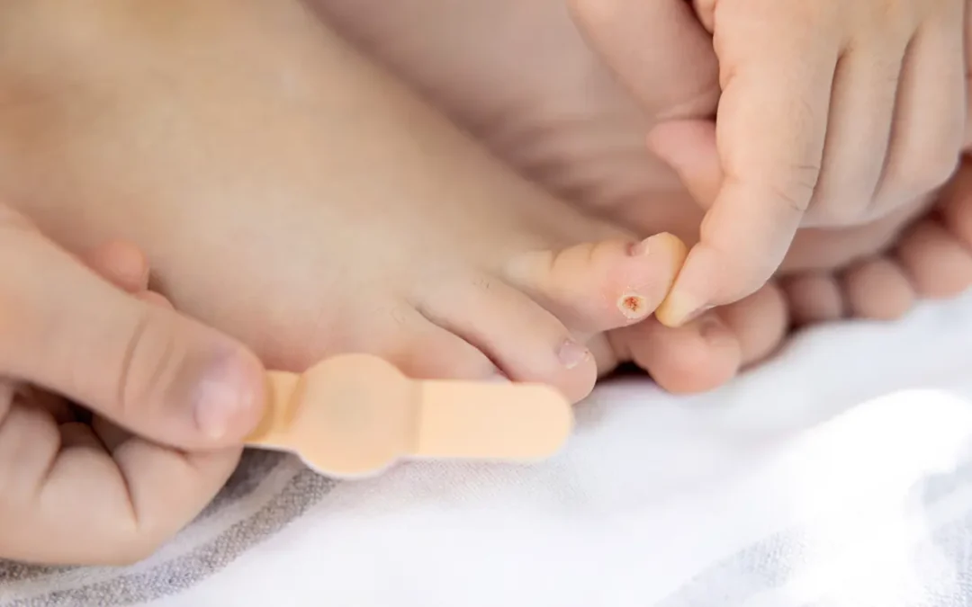 Common Treatments for Foot Corns: What Actually Works