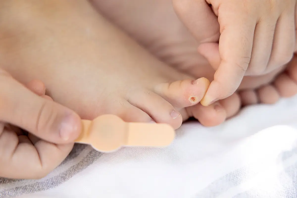 close up of blister or corn care close up of blister or corn care