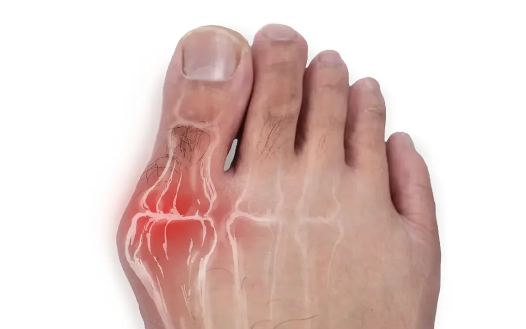 Will Bunions Go Away on Their Own? Myths and Facts