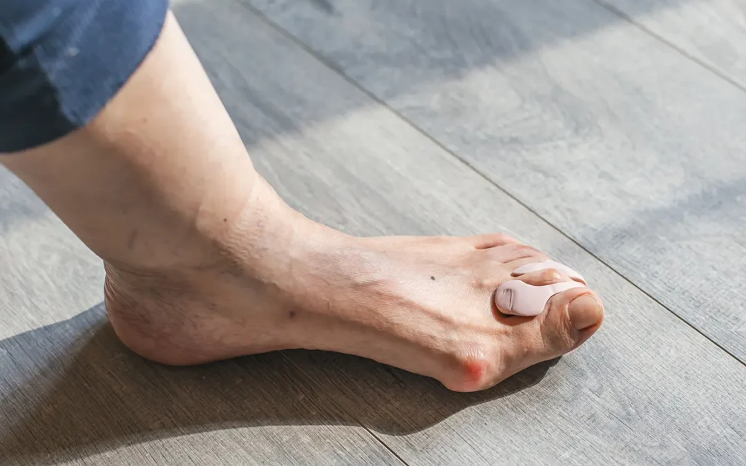 Bunion Treatment Options: Finding Relief and Correction