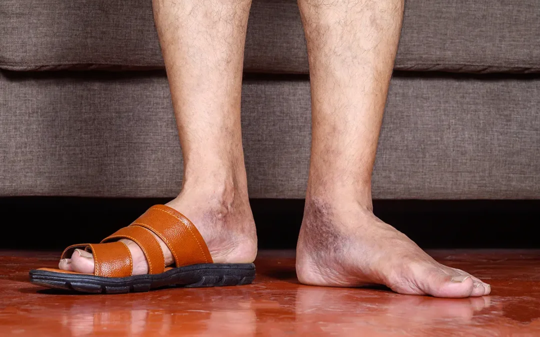 Medical Conditions That May Lead to Poor Circulation in the Feet